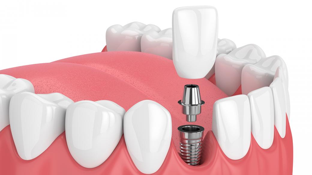 Dental Implants