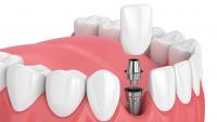 model of dental implant and crown in mouth