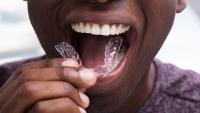 Man Adjusting Transparent Aligners In His Teeth