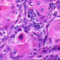 cancerous oral tissue